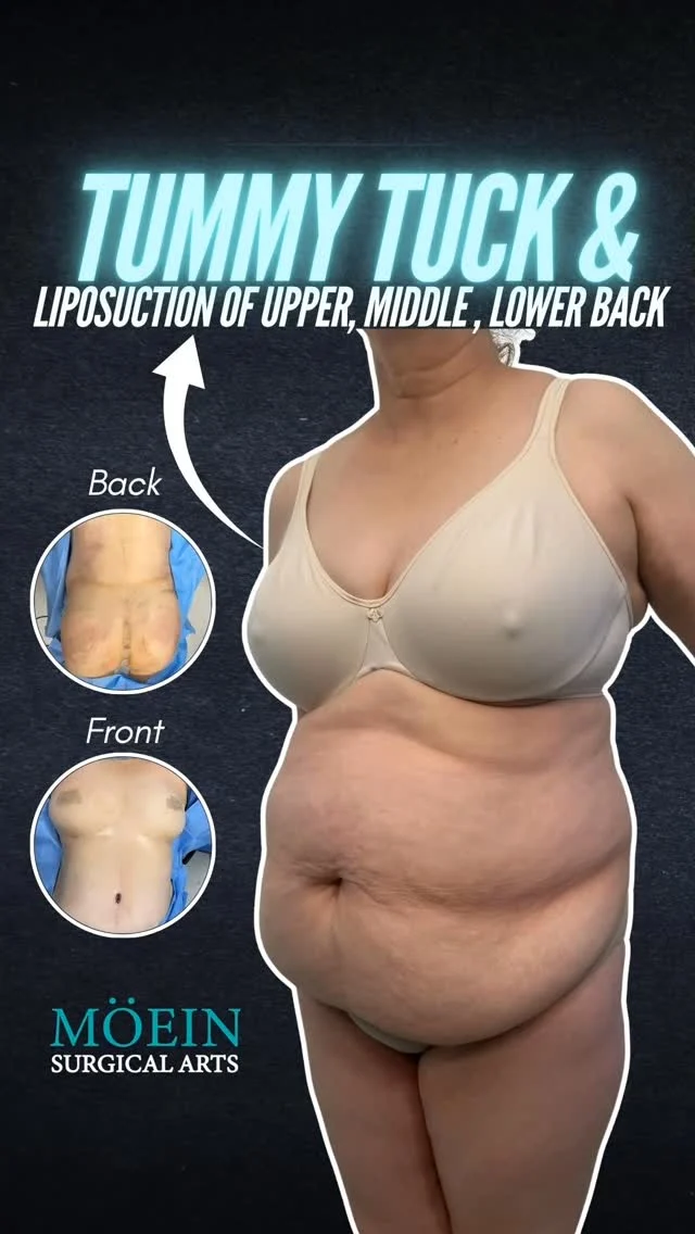 ✨🔥 Tummy Tuck & Back Liposuction Transformation!

BEFORE:
😟 Loose, sagging abdominal skin
😟 Stubborn fat in upper, middle & lower back
😟 Lack of waist definition and body contour

AFTER:
😊 Tighter, flatter abdomen with improved firmness
😊 Smoothly contoured upper, middle & lower back
😊 Enhanced waistline with a more sculpted, balanced silhouette

Tummy Tuck combined with Liposuction of the upper, middle & lower back helps remove excess skin and stubborn fat—creating a slimmer, more defined body shape with long-lasting results.

Ready to transform your shape and boost your confidence?

Let’s talk. 💬
📲 DM us
📞 (310) 861-4093
🌐 moeinsurgicalarts.com
📧 Appointment@msurgicalarts.com
•
•
TummyTuck Liposuction BodyContouring SnatchedWaist drmoein moeinsurgicalart