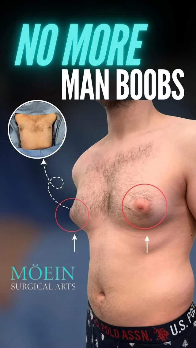 Grade 2 Gynecomastia Surgery 💪

✨ Achieve a flatter, more masculine chest with advanced Grade 2 Gynecomastia treatment at Moein Surgical Arts.

🫤 BEFORE: Moderate chest enlargement with excess glandular tissue and fat — creating a puffy, rounded appearance that doesn’t respond to diet or exercise, often affecting confidence and comfort.

💪 AFTER: A firmer, flatter, and more sculpted chest through precise gland removal and liposuction — restoring a natural masculine contour with minimal scarring and long-lasting results.

At Moein Surgical Arts, Grade 2 Gynecomastia Surgery is designed for men with noticeable chest fullness without significant skin sagging — helping redefine the chest and restore confidence in everyday life and fitted clothing.

Let’s talk. 💬
📲 DM us
📞 (310) 861-4093
🌐 moeinsurgicalarts.com
📧 Appointment@msurgicalarts.com

#Gynecomastia #Grade2Gynecomastia #ChestSurgery #MensConfidence #BodyContouring #GynecomastiaSurgery #MoeinSurgicalArts