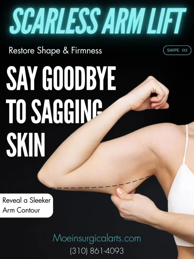 Scarless Arm Lift at Moein Surgical Arts ✨

Loose, sagging skin on the arms can be frustrating—especially when it doesn’t improve with diet or exercise. Whether due to weight loss or aging, it can affect both your appearance and confidence. A Scarless Arm Lift is an advanced solution designed to contour and tighten your arms without visible scarring.

At Moein Surgical Arts, we focus on:

✨ Minimally invasive techniques to tighten and sculpt the arms

✨ Removing excess fat for a smoother, more toned appearance

✨ Enhancing natural contours without traditional long scars

Every treatment is customized to your unique body and goals—helping you achieve slimmer, more defined arms while maintaining a natural look. 💖

📲 DM us

📞 (310) 861-4093

🌐 moeinsurgicalarts.com

📧 Appointment@msurgicalarts.com

📅 Book your consultation today and take the first step toward confident, sculpted arms!

#scarlessarmlift #moeinsurgicalarts #drmoein #armlift #BodyContouring
