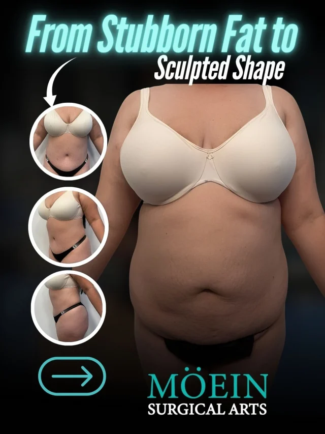From Stubborn Fat → Sculpted Shape ✨
Not all transformations are about “losing weight”…
 Some are about reshaping what’s already there.
This case focused on 360° contouring + volume restoration —
 creating balance, not just reduction.
Think:
 • A tighter, flatter core
 • A more defined waistline from every angle
 • Natural curves restored using your own fat
No extremes. No “overdone” look.
 Just a body that feels proportional, sculpted, and yours again.
—
💬 Real question:
 If you could change one area of your body after weight loss or pregnancy… what would it be?
(Comment it below — we’ll personally guide you 👇)
—
🎥 Want to see how this transformation is actually done?
 Comment “SCULPT” and I’ll send you the breakdown.
—
📍 Moein Surgical Arts
 📲 DM “SCULPT” for a private consultation