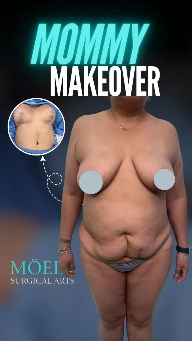 ✨ She gave everything to motherhood… now it was time to give something back to herself.

Pregnancy, weight changes, and years of putting everyone else first can leave behind loose skin, stretched muscles, and stubborn areas that no workout seems to fix.

That’s why so many women are choosing a Mommy Makeover — not to look like someone else, but to feel confident in their own body again. 💖
At Moein Surgical Arts, every Mommy Makeover is fully customized and may include a tummy tuck, breast enhancement, and body contouring to help restore natural balance and shape.

The goal isn’t “perfection.”

It’s feeling comfortable in photos, confident in clothes, and happy when you look in the mirror again. ✨

If you could change ONE thing after pregnancy… what would it be? 👇

📍 Beverly Hills, CA
📞 (310) 861-4093
🌐 moeinsurgicalarts.com

#mommymakeoverjourney #postpregnancybody #tummytuckjourney #mommymakeoverla