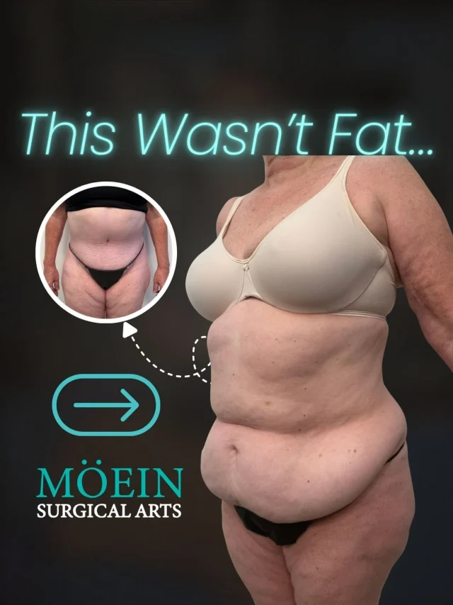 Panniculectomy Surgery ✨

Not every transformation is about “losing weight”…
Some are about removing the physical burden left behind after massive weight loss or pregnancy.
This case focused on removing excess hanging abdominal skin and restoring comfort, mobility, and confidence.

Think:
• A flatter, lighter abdominal area
• Reduced skin irritation and discomfort
• Improved movement and daily comfort
• A smoother, cleaner body contour

Panniculectomy is not about creating an “overdone” look.
It’s about helping patients feel more comfortable in their own body again.

✨ Functional improvement meets aesthetic refinement.

💬 Real question:
What’s the biggest challenge you’ve faced after weight loss or pregnancy?
(Comment below — we’ll personally guide you 👇)
🎥 Want to see how this transformation is actually done?
Comment “SCULPT” and I’ll send you the breakdown.

📍 Moein Surgical Arts
📲 DM “SCULPT” for a private consultation
