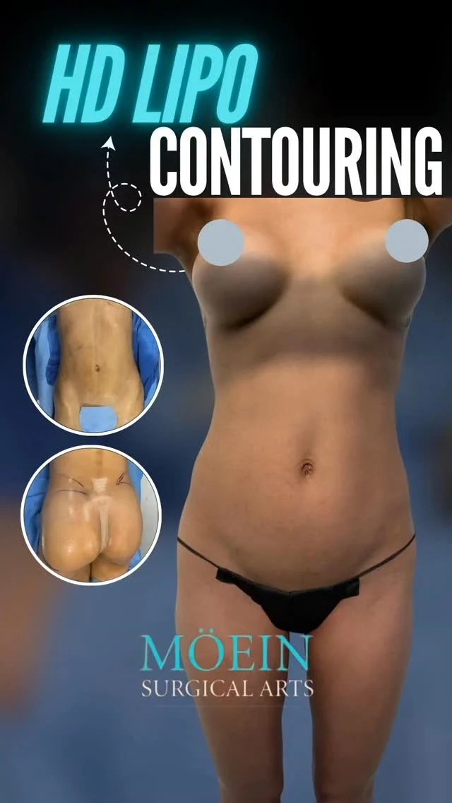 ✨ She worked hard for her body… now it’s time to reveal the definition underneath.

Even with consistent workouts and a healthy lifestyle, stubborn fat and lack of muscle definition can make it difficult to achieve that sculpted, athletic look.

That’s why more patients are choosing HD Lipo Contouring — a precision body sculpting procedure designed to enhance natural muscle lines and create a sharper, more defined appearance. 💪✨

At Moein Surgical Arts, every HD Lipo Contouring procedure is fully customized to highlight your body’s natural anatomy while maintaining balanced, natural-looking results.

The goal isn’t to look “fake.”

It’s to feel stronger, leaner, and more confident every time you look in the mirror. 🔥

If you could sculpt ONE area of your body… what would it be? 👇

📍 Beverly Hills, CA
📞 (310) 861-4093
🌐 moeinsurgicalarts.com

#hdlipo #bodycontouring #lipocontouring #highdefinitionlipo #BodyGoals