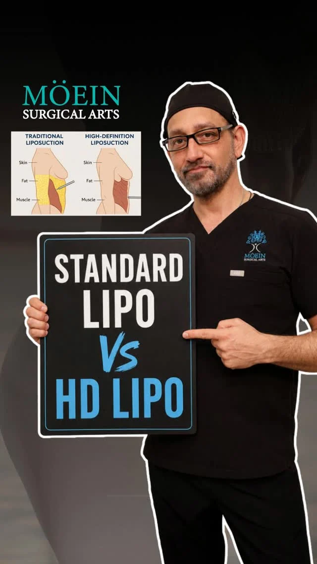 Standard Liposuction VS HD Liposuction ✨

Not all liposuction techniques deliver the same results. While Standard Liposuction focuses on removing excess fat, HD Liposuction is designed to sculpt and define the body for a more athletic, contoured appearance.

At Moein Surgical Arts, we focus on:

✨ Standard Liposuction:
• Removes stubborn fat deposits
• Creates a slimmer, smoother body contour
• Ideal for overall fat reduction and reshaping

✨ HD Liposuction:
• Enhances muscle definition and body contours
• Creates a more sculpted, athletic appearance
• Uses precision contouring techniques for high-definition results

Every treatment is customized to your body type and aesthetic goals—helping you achieve natural-looking, confidence-boosting results. 💖

📲 DM us
📞 (310) 861-4093
🌐 moeinsurgicalarts.com
📧 Appointment@msurgicalarts.com
📅 Book your consultation today and discover which liposuction option is right for you!

#hdliposuction #bodycontouring #bodysculpting #moeinsurgicalarts #drmoein