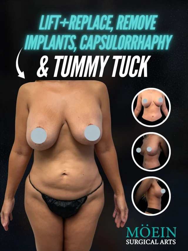 ✨ Total Body Restoration: Lift + Replace, Implant Removal, Capsulorrhaphy & Tummy Tuck
Not every transformation is about changing how you look…
Some are about restoring comfort, confidence, and balance after pregnancy, weight changes, or previous implants no longer feel right for your body.
This case focused on:
• Removing and replacing breast implants
• Internal capsule repair (Capsulorrhaphy) for better implant support and positioning
• Breast lifting to restore a youthful contour
• Tummy tuck surgery to tighten and flatten the abdominal area
Think:
• Improved breast shape, symmetry, and support
• A flatter, firmer waistline
• Better body balance and proportion
• More confidence in and out of clothing
• A smoother, more refined silhouette
This transformation is not about looking “overdone.”
It’s about creating results that feel natural, balanced, and truly aligned with the patient’s body goals.
✨ Functional restoration meets aesthetic refinement.
💬 Real question:
What’s been the hardest part of your body transformation journey after pregnancy or weight changes?
(Comment below — we’ll personally guide you 👇)
🎥 Want to see how this transformation is actually done?
Comment “SCULPT” and I’ll send you the breakdown.
📍 Moein Surgical Arts
📲 DM “SCULPT” for a private consultation

#implants #drmoein #capsularrophy