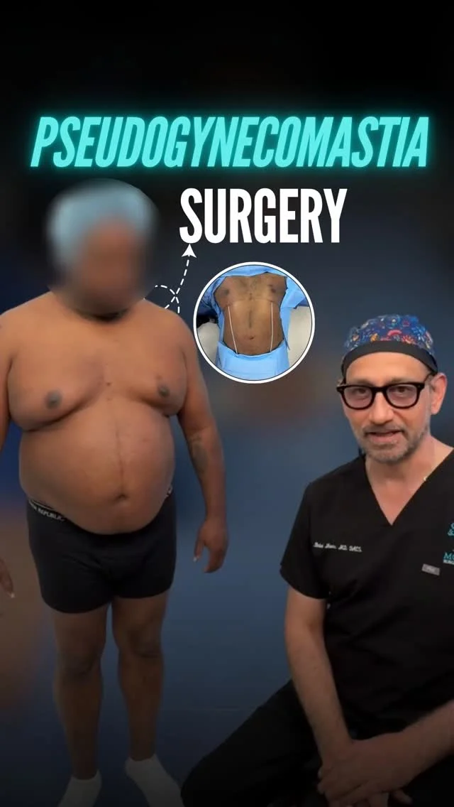 He worked hard for his chest… now it’s time to reveal the definition underneath.

Even with consistent chest workouts and a healthy lifestyle, stubborn fat in the pectoral area can make it difficult to achieve that flat, sculpted, athletic look.
That’s why more patients are choosing Pseudogynecomastia Surgery — a precision body contouring procedure designed specifically to eliminate resistant fat cells in the chest, enhance natural pectoral lines, and restore a firmer, more masculine appearance. 💪✨

At Moein Surgical Arts, every Pseudogynecomastia procedure is fully customized to highlight your chest’s natural anatomy while maintaining balanced, natural-looking results.

The goal isn’t just to remove fat.

It’s to feel stronger, leaner, and completely confident whether you're wearing a fitted shirt or going shirtless. 🔥
Ready to redefine your chest contour? Let us know your goals below! 👇

📍 Beverly Hills, CA
📞 (310) 861-4093
🌐 moeinsurgicalarts.com

#pseudogynecomastia #malechestreduction #chestcontouring #maleplasticsurgery #PectoralDefinition