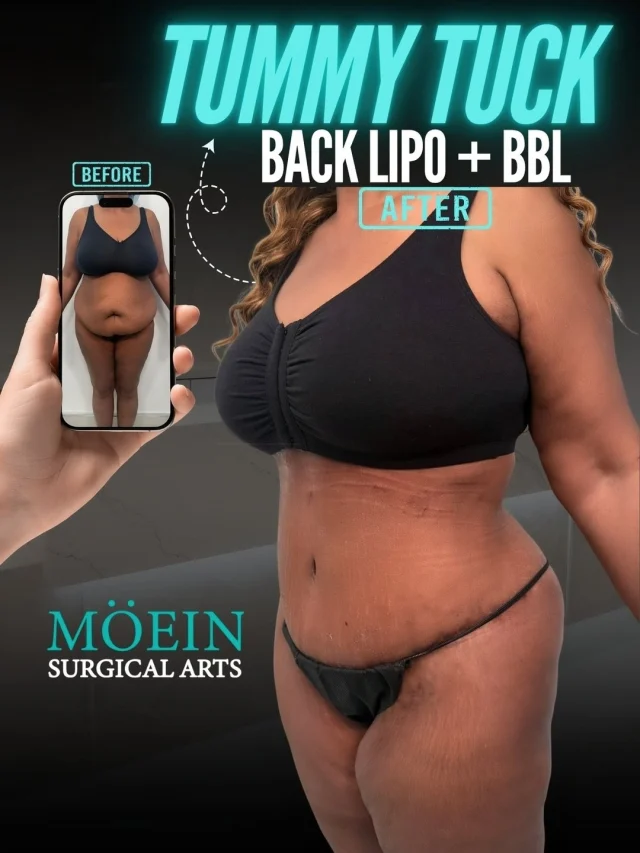 ✨ Tummy Tuck + Back Lipo + BBL ✨

Not every transformation is about "looking different"… Some are about finally feeling at home in your own body.

This case focused on creating a smoother waistline, removing stubborn fat from the back, and enhancing natural curves with fat transfer to the buttocks — restoring balance, proportion, and confidence that can be affected by weight changes, pregnancy, or simply time.

Think:
✨ A flatter, tighter abdomen
✨ A more sculpted back and waistline
✨ Enhanced curves and improved body proportions
✨ Renewed confidence in how you look and feel

A Tummy Tuck + Back Lipo + BBL isn't about looking artificial. It's about refining your natural shape and helping you feel like the best version of yourself. ✨
Functional harmony meets aesthetic refinement.

💬 Real question: What's one thing about your body you wish you could change — not for anyone else, but purely for yourself? (Comment below — we'll personally guide you 👇)

🎥 Want to see how this transformation is actually done? Comment "CURVES" and I'll send you the full breakdown.
📍 Moein Surgical Arts
📲 DM "CURVES" for a private consultation
.
.
#TummyTuck #BBL #BackLipo #PlasticSurgery #BeforeAndAfter