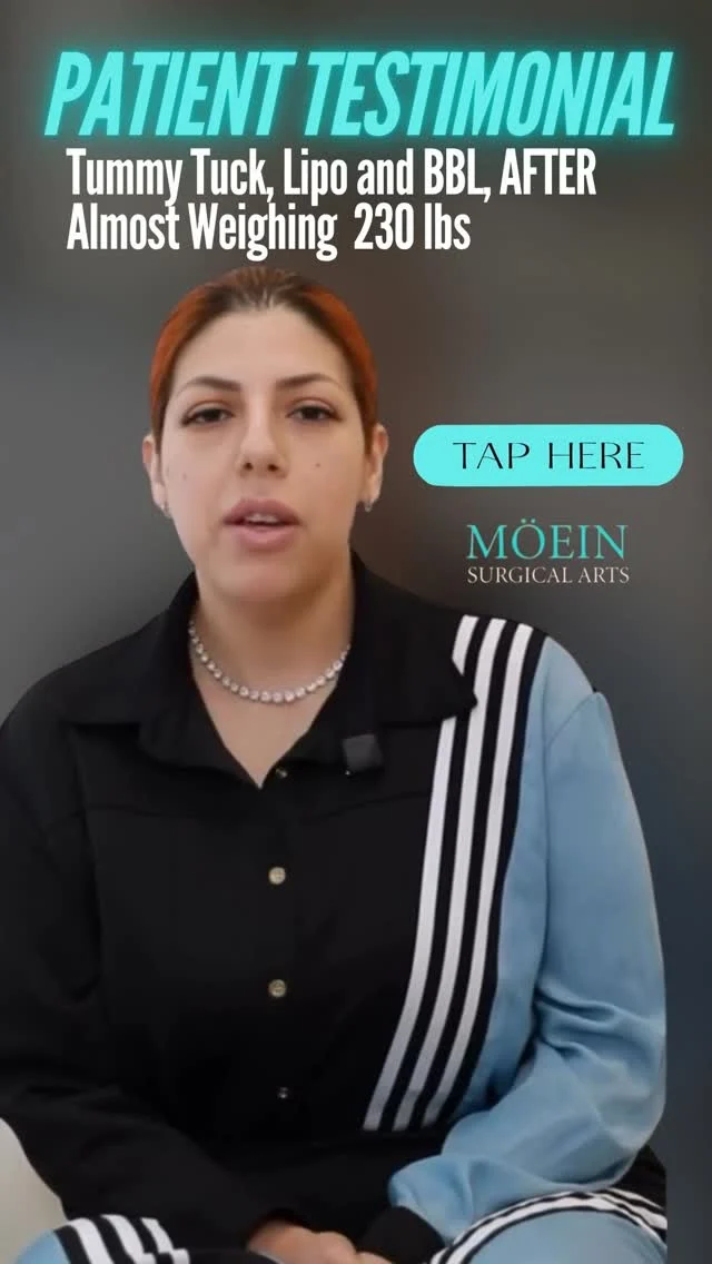 “After everything I’ve achieved, I’m ready to feel as confident as I deserve to.”

Following an incredible 100+ lb weight loss journey with gastric sleeve surgery, this patient has already transformed her life through dedication and hard work. Now, she's taking the final step in her body contouring journey with a tummy tuck and liposuction of the abdomen, arms, and chin.

This procedure isn't about changing who she is — it's about revealing the results that excess skin and stubborn areas can hide. By refining her shape and enhancing her natural contours, we're helping her celebrate the success she's worked so hard to achieve.

Confidence isn't just about the number on the scale. It's about feeling comfortable, empowered, and proud of the reflection you see every day.

We're honored to help her complete this chapter of her transformation.

📍 Los Angeles
🌐 moeinsurgicalarts.com

#WeightLossJourney #BodyContouring #TummyTuck #Liposuction #TransformationJourney