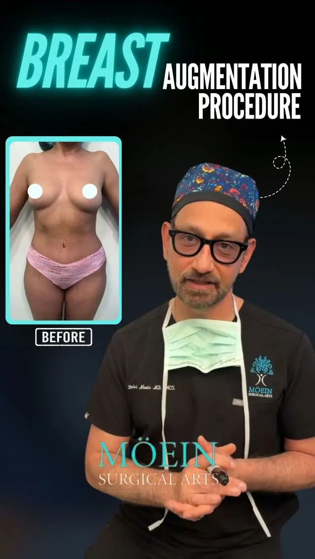 Breast Augmentation: Designed Around You✨

Every woman's body is unique—and so are her goals.

Whether you've experienced changes after pregnancy, breastfeeding, weight loss, or simply want to enhance your natural shape, breast augmentation is about creating balance, proportion, and confidence that feels authentically you.

✨ Restore lost volume and fullness
✨ Enhance natural curves and symmetry
✨ Improve overall body proportions
✨ Personalized results that complement your physique

At Moein Surgical Arts, every breast augmentation procedure is customized to your anatomy, lifestyle, and aesthetic goals. Our focus is on achieving soft, natural-looking results that help you feel confident—not overdone.

Because the best results are the ones that look like they were always meant for you.

💬 Thinking about breast augmentation? Comment "INFO" or send us a DM to learn more about your options.
📍 Moein Surgical Arts
📲 Schedule your private consultation today.

#BreastAugmentation #BreastEnhancement #PlasticSurgery