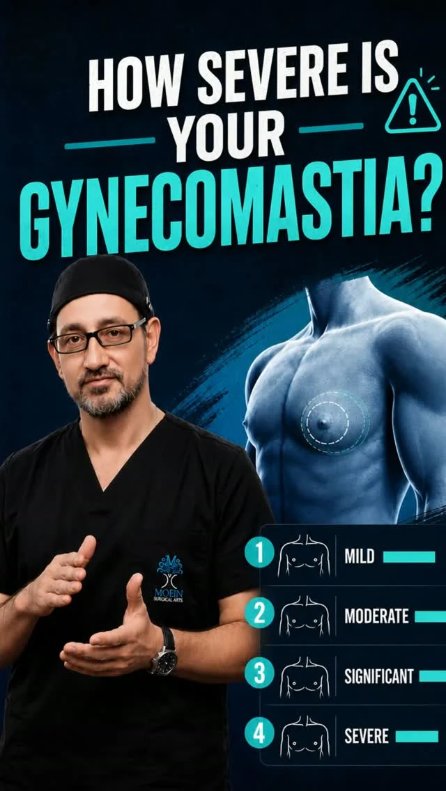 How severe is your gynecomastia? 💪

Not all gynecomastia is the same—and the right treatment depends on your grade.
🔹 Grade 1: Mild enlargement with little or no excess skin.
 🔹 Grade 2: Moderate enlargement with minimal skin excess.
 🔹 Grade 3: Larger chest with noticeable excess skin.
 🔹 Grade 4: Severe enlargement with significant loose skin, requiring advanced correction.

✨ Before Surgery, We Consider:
 ✔️ Your gynecomastia grade
 ✔️ Your overall health and weight
 ✔️ The best surgical approach for natural-looking results

At Moeinsurgicalarts, every procedure is customized using the right combination of gland removal, liposuction, and skin tightening to create a flatter, more masculine chest.

📍 Moein Surgical Arts
📲 DM "Gynecomastia" to schedule your private consultation.

#Gynecomastia #GynecomastiaSurgery #MensHealth #ChestContouring #GynecomastiaLA