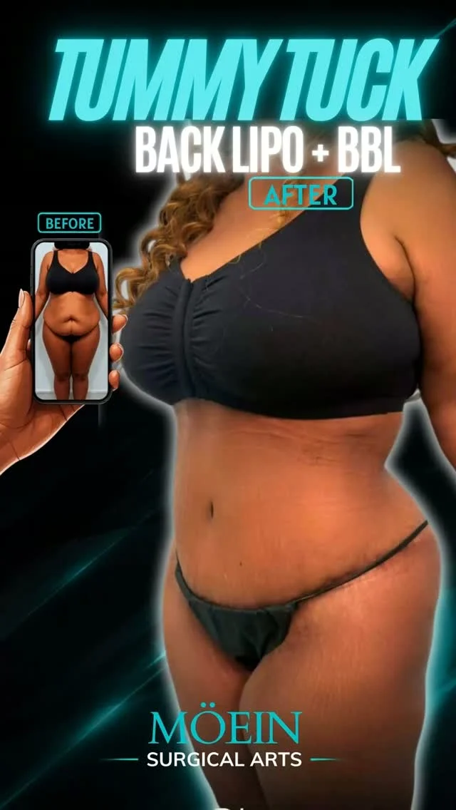 Watch a Complete Tummy Tuck + Back Liposuction + BBL Transformation 🎥✨

Ever wonder what it actually takes to create a flatter waist, remove stubborn back fat, and enhance natural curves?

In this video, you'll see the procedure from start to finish as Dr. Moein performs a customized body contouring transformation designed to improve balance, shape, and proportion.

This procedure may include:
✨ Tummy Tuck to remove excess skin and tighten the abdomen
✨ Back Liposuction to sculpt the waist and eliminate stubborn fat
✨ Brazilian Butt Lift (BBL) using your own fat to create natural-looking curves

Every patient is unique, which is why every surgical plan is personalized to their anatomy and goals.

🎥 Watch the full procedure to see how these techniques work together to achieve a smoother, more sculpted silhouette.

💬 Have questions about recovery, results, or whether you're a candidate? Leave a comment or send us a DM.

📍 Moein Surgical Arts
📞 (310) 861-4093
🌐 moeinsurgicalarts.com

#TummyTuck #BackLiposuction #BBL #BodyContouring
