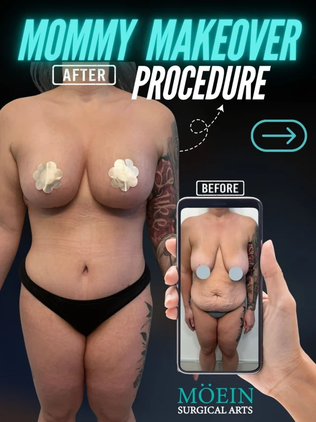 Mommy Makeover Transformation ✨

Motherhood changes your body—but it doesn't mean you can't feel confident in it again.
A Mommy Makeover is a personalized combination of procedures designed to restore your shape after pregnancy and childbirth. Every treatment plan is customized to your unique goals, helping you achieve natural, balanced results.

Think:
✨ A flatter, tighter abdomen
✨ Restored breast shape and volume
✨ A more sculpted waistline and smoother body contours
✨ Natural-looking results that complement your figure

No extremes. No "overdone" look.
Just a refreshed, proportionate body that still looks like you.
—
💬 Real question:
If you could change one area of your body after pregnancy… what would it be?
(Comment below—we'd love to help guide you. 👇)
—
🎥 Want to see how a Mommy Makeover is performed?
Comment "MOMMY" and we'll send you the full procedure breakdown.
—
📍 Moein Surgical Arts
📲 DM "MOMMY" for a private consultation.

#drmoein #mommymakeover #moeinsurgicalarts