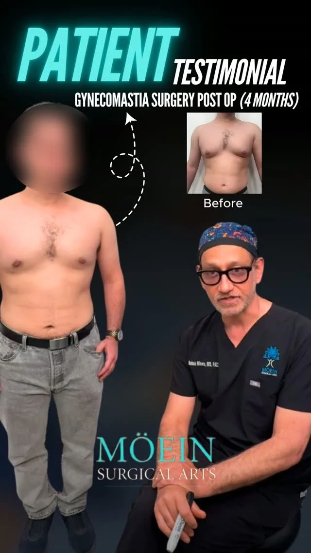 Gynecomastia Surgery – 4 Months Post-Op ✨

Sometimes the biggest transformation isn’t just physical…
It’s the confidence to wear a fitted shirt, go to the beach, or simply feel comfortable in your own body again.
This patient is now 4 months after gynecomastia surgery, and the results continue to improve as healing progresses.

Think:
• A flatter, more masculine chest
• Improved chest definition
• Clothing that fits with confidence
• Natural-looking, long-lasting results

Gynecomastia surgery isn’t about chasing perfection.
It’s about restoring confidence and helping patients feel like themselves again.

✨ Confidence restored. Results that continue to improve with time.

💬 Real question:
If gynecomastia has affected your confidence, what has been the biggest challenge for you?

(Comment below—we’re happy to answer your questions. 👇)

🎥 Want to learn how gynecomastia surgery is performed and who is a good candidate..
Comment "CHEST" and we’ll send you the full breakdown.

📍 Moein Surgical Arts
📲 DM "CHEST" to schedule your private consultation.

#drmoein #gynecomastiasurgery #patienttestimonial #moeinsurgicalarts #manboobs