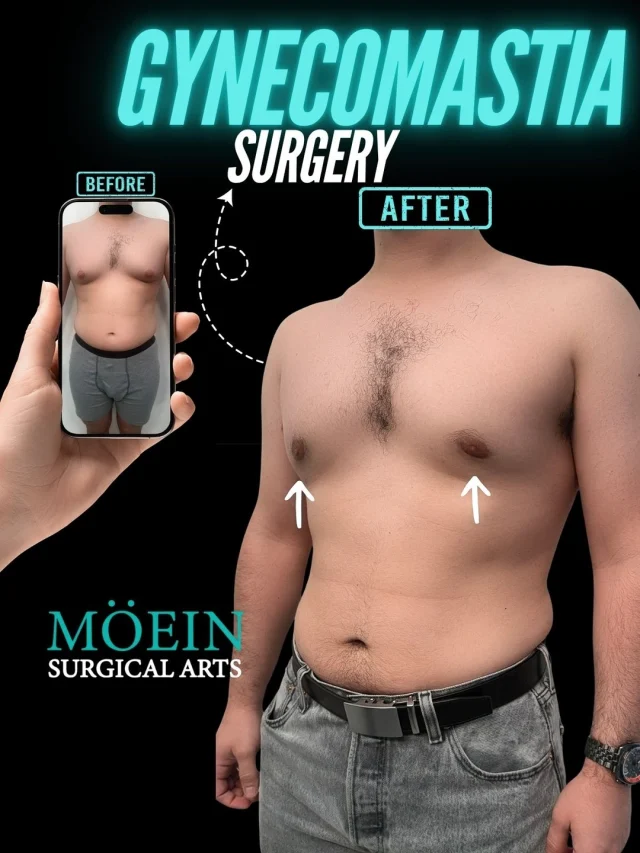 Gynecomastia Surgery 💪✨

Not every transformation is about building a bigger chest… Some are about finally revealing the masculine contour that's been hidden all along.
This case focused on removing excess glandular tissue and stubborn fat to create a flatter, more defined chest — restoring confidence that can be affected by genetics, hormones, weight changes, or certain medications.

Think:
✨ A flatter, more masculine chest
✨ Improved chest definition and contour
✨ Better fit in T-shirts and fitted clothing
✨ Renewed confidence at the gym, the beach, and in everyday life.

Gynecomastia surgery isn't about looking overdone. It's about restoring a natural masculine appearance and helping you feel comfortable in your own body. ✨

Functional confidence meets aesthetic refinement.

💬 Real question: If gynecomastia has affected your confidence, what's been the biggest challenge for you? (Comment below — we'll personally guide you 👇)

🎥 Want to see how this transformation is actually done? Comment "CHEST" and I'll send you the full breakdown.
📍 Moein Surgical Arts
📲 DM "CHEST" for a private consultation.
.
.
#Gynecomastia #MaleChestReduction #GynecomastiaSurgery #MensHealth