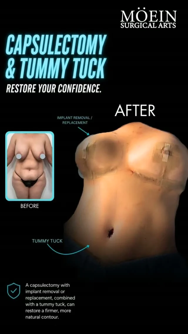 Watch a Complete Capsulectomy + Tummy Tuck Transformation 🎥✨

Ever wonder what it takes to remove problematic breast implant capsules while restoring a flatter, firmer abdomen?

In this video, you'll see the procedure from start to finish as Dr. Moein performs a customized transformation designed to improve comfort, confidence, and body contour.

This procedure may include:
✨ Capsulectomy to remove the scar tissue capsule surrounding breast implants and address implant-related concerns
✨ Tummy Tuck to remove excess skin, tighten the abdominal muscles, and create a smoother, flatter midsection

Every patient is unique, which is why every surgical plan is personalized to their anatomy, concerns, and goals.

🎥 Watch the full procedure to see how these techniques work together to restore a more balanced, natural-looking result.

💬 Have questions about recovery, implant removal, or whether you're a candidate? Leave a comment or send us a DM.

📍 Moein Surgical Arts
📞 (310) 861-4093
🌐 moeinsurgicalarts.com

#Capsulectomy #TummyTuck #BreastImplantRemoval