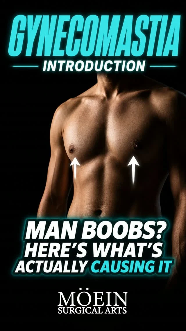 What is Gynecomastia? 🤔

It's more common than you think—affecting up to 1 in 3 men at some point in their lives.

🔹 What it is: Enlarged male breast tissue caused by a hormonal imbalance between estrogen and testosterone.
 🔹 What it's not: It's not the same as "man boobs" from excess fat alone—it involves actual glandular tissue growth.
 🔹 Common causes: Puberty, hormone changes, certain medications, genetics, or weight fluctuations.
 🔹 Who it affects: Men of all ages, body types, and fitness levels.

✨ The Good News:
 Gynecomastia is highly treatable. With the right surgical approach, you can achieve a flatter, firmer, more masculine chest—permanently.

At Moein Surgical Arts, we start every journey with a thorough evaluation to understand your unique case and walk you through your options.

📍 Moein Surgical Arts
 📲 DM "Gynecomastia" to schedule your private consultation.

#Gynecomastia #GynecomastiaSurgery #MensHealth #ChestContouring