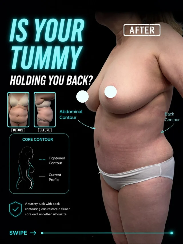 ✨ Tummy Tuck + Upper, Middle & Lower Back Liposuction ✨

Sometimes the biggest transformation isn't about losing more weight—it's about reshaping your body to reveal the contours you've worked so hard for.
This procedure combined a Tummy Tuck with liposuction of the upper, middle, and lower back to create a smoother, more sculpted silhouette. By removing excess skin, tightening the abdominal muscles, and contouring the back, this customized approach helps achieve improved balance and definition from every angle.

Think:
✨ A flatter, firmer abdomen
✨ A slimmer, more sculpted back
✨ Improved waistline definition
✨ Better body proportions and contour
✨ Greater confidence in fitted clothing and everyday life

Every procedure is customized to the patient's unique anatomy and goals, creating natural-looking results that enhance overall body harmony.
Functional improvement meets aesthetic refinement.

💬 Real question: If you could improve one area of your body, what would it be? Let us know in the comments—we'd love to help guide you. 👇
🎥 Want to see how this transformation is performed? Comment "BODY" and we'll send you the full procedure breakdown.
📍 Moein Surgical Arts
📲 DM "BODY" for a private consultation.
.
.
#TummyTuck #Liposuction #BackLiposuction #BodyContouring