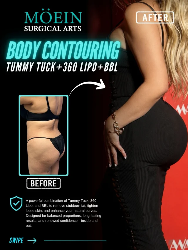 Not every transformation is about weight loss. Some are about reshaping the whole silhouette. ✨
This patient didn't just want a flatter stomach — she wanted curves, balance, and confidence in everything she wears.

The combo:
 ✔️ 360 Liposuction — full midsection contour
 ✔️ Tummy Tuck — tighter core, no excess skin
 ✔️ Muscle Repair — restored structure
 ✔️ BBL — natural curves, real projection

Before: loose skin, no shape.
 After: snatched waist, lifted curves, proportion from every angle.

Treat the whole body — not just one area — and this is what happens. 👀

📲 DM to book your consultation
 🌐 moeinsurgicalarts.com

#drmoein #tummytuck #liposuction360 #bbl #bodycontouring