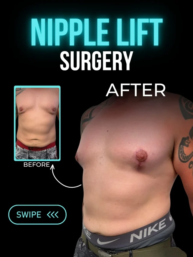 Nipple Lift Surgery 💪✨

A masculine chest isn't about having bigger muscles—it’s about having the right contour.
BEFORE
❌ Sagging or downward-pointing nipples
❌ Asymmetry or uneven nipple position
❌ Feeling uncomfortable in fitted shirts, at the gym, or by the pool

AFTER
✔ A higher, more balanced nipple position
✔ Improved symmetry with a natural masculine appearance
✔ Greater confidence in everyday life
Nipple lift surgery repositions and elevates the nipple-areolar complex to restore a firmer, more proportionate chest contour. Every treatment plan is tailored to the individual, helping achieve balanced, natural-looking results.
If you're tired of hiding your chest, it may be time to explore your options.

📲 Ready to start your journey? DM me to book your consultation
📞 (310) 861-3176
🌐 www.moeinsurgicalarts.com
📧 appointment@msurgicalarts.com

#drmoein #nipplelift #moeinsurgicalarts #malechest