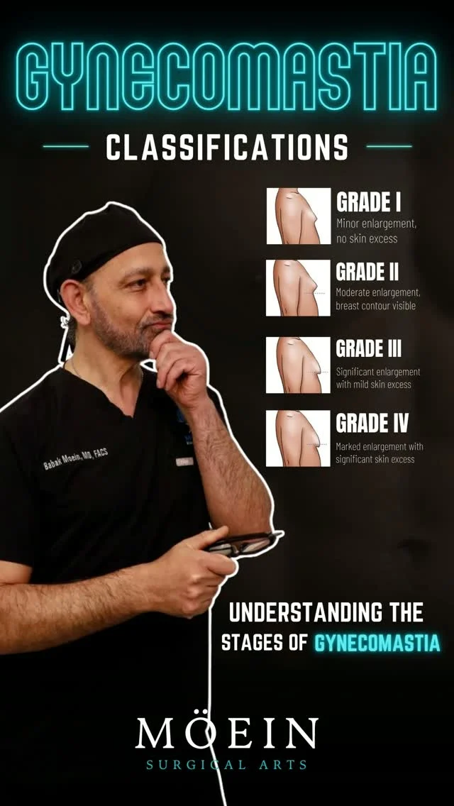 Classification of Gynecomastia 🤔

Did you know that gynecomastia is classified into different grades based on the amount of excess breast tissue and skin?
🔹 Grade 1: Small enlargement with little or no excess skin.
🔹 Grade 2: Moderate enlargement without significant excess skin.
🔹 Grade 3: Moderate enlargement with excess skin that may require skin tightening.
🔹 Grade 4: Significant enlargement with excess skin, resembling a more feminine chest contour.

Every grade requires a personalized treatment plan. The appropriate surgical technique depends on the severity of the condition, skin quality, and your desired outcome.

✨ The Good News:
Gynecomastia surgery can create a flatter, firmer, and more masculine chest with long-lasting, natural-looking results. An expert evaluation is the first step toward determining the best approach for your specific grade.

📍 Moein Surgical Arts
📲 DM "Gynecomastia" to schedule your private consultation.

#Gynecomastia #GynecomastiaSurgery #MensHealth #ChestContouring