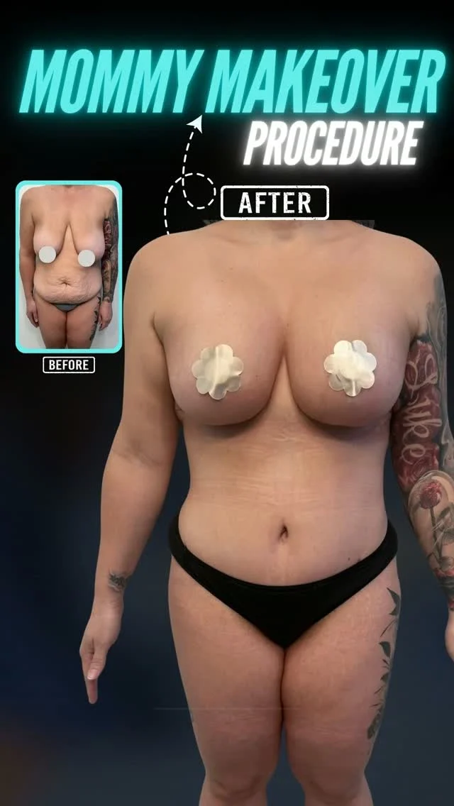 Mommy Makeover Transformation ✨

Motherhood changes your body—but it doesn't mean you can't feel confident in it again.
A Mommy Makeover is a personalized combination of procedures designed to restore your shape after pregnancy and childbirth. Every treatment plan is customized to your unique goals, helping you achieve natural, balanced results.

Think:
✨ A flatter, tighter abdomen
✨ Restored breast shape and volume
✨ A more sculpted waistline and smoother body contours
✨ Natural-looking results that complement your figure

No extremes. No "overdone" look.
Just a refreshed, proportionate body that still looks like you.

🎥 Watch the Mommy Makeover procedure being performed and see the surgical process step by step.
💬 Have questions about Mommy Makeover surgery? Drop them below—we'd love to help guide you. 👇

📍 Moein Surgical Arts
📲 DM "MOMMY" for a private consultation.

#drmoein #mommymakeover #moeinsurgicalarts