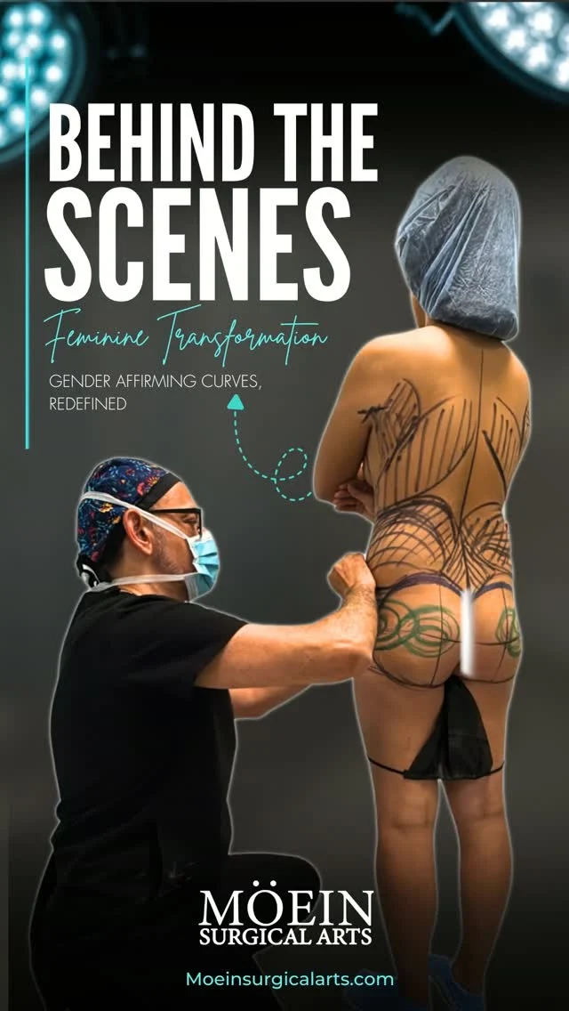 Behind the Scenes: Feminine Transformation — Gender-Affirming Curves, Redefined ✨

Step inside the operating room and see how precision, artistry, and personalized surgical planning come together to create beautifully balanced feminine contours.

Gender-affirming body contouring is designed to enhance feminine proportions by strategically sculpting areas such as the waist, abdomen, hips, and other body contours. Every treatment is carefully customized to the patient’s anatomy, goals, and desired aesthetic.

✨ Feminine waistline definition
✨ Enhanced curves & proportions
✨ Sculpted, balanced body contours
✨ Personalized gender-affirming transformation

This is more than body contouring—it’s about creating harmony between your natural anatomy and the feminine silhouette you envision for yourself.
💬 What would you like to see more of behind the scenes? Let us know in the comments below! 👇

📍 Moein Surgical Arts
📲 DM "CURVES" to learn more or schedule your private consultation.
.
.
#GenderAffirmingSurgery #GenderAffirmingCare #FeminineTransformation #DRMOEIN #moeinsurgicalarts