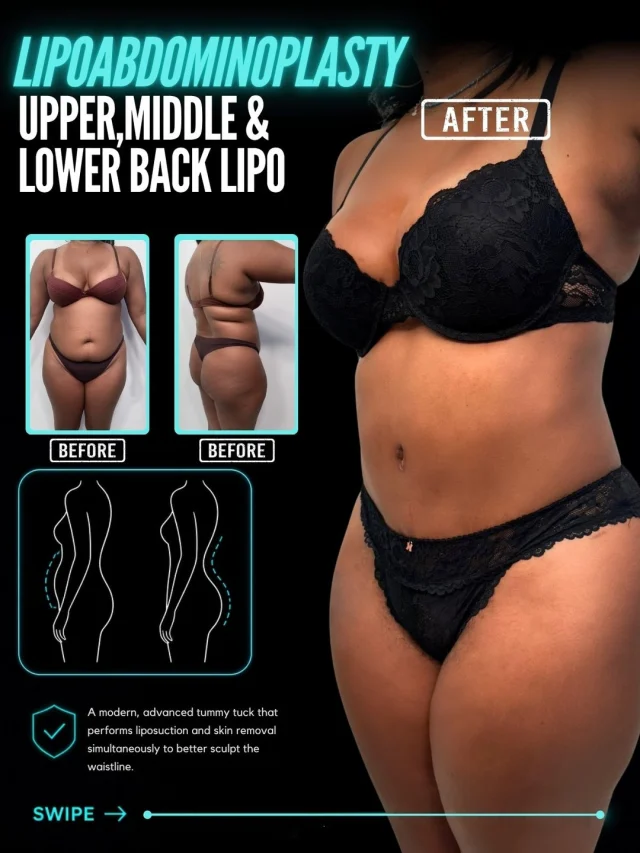 Lipoabdominoplasty + Back Liposuction ✨

A flatter abdomen and a more sculpted back can completely transform your overall silhouette.
BEFORE
❌ Excess abdominal skin and stubborn fat
❌ Loose or weakened abdominal contour
❌ Unwanted fullness across the upper, middle & lower back
❌ Difficulty achieving a smooth, defined waistline
AFTER
✔ Flatter, firmer abdominal contour
✔ Refined waistline and body proportions
✔ Sculpted upper, middle & lower back
✔ Smoother, more balanced overall silhouette

Lipoabdominoplasty combines abdominal skin tightening and contouring with liposuction to create a more defined midsection. Combined with upper, middle & lower back liposuction, the result is a smoother, more proportionate body contour from every angle.
Every treatment plan is customized to the patient's anatomy and aesthetic goals, with a focus on balanced, natural-looking results.
If you're ready to reshape your silhouette, it may be time to explore your options.

📲 Ready to start your journey? DM me to book your consultation
📞 (310) 861-3176
🌐 www.moeinsurgicalarts.com
📧 appointment@msurgicalarts.com

#drmoein #lipoabdominoplasty #liposuction #backliposuction #bodycontouring