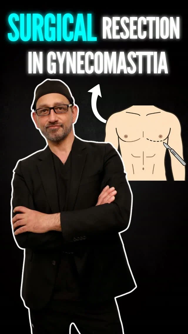 Surgical Resection for Gynecomastia 🩺

For some cases of gynecomastia, removing excess glandular breast tissue is an important part of achieving a flatter, more masculine chest.

🔹 Surgical Resection — Precisely removes firm, glandular breast tissue that may not respond to liposuction alone
🔹 Targeted Treatment — Addresses the underlying tissue contributing to chest fullness
🔹 Customized Approach — The extent of resection depends on the severity and anatomy of each case
🔹 Chest Contouring — Designed to create a flatter, more defined chest while maintaining natural proportions

✨ Every case of gynecomastia is different. An expert evaluation can help determine whether surgical resection is the right approach for you.

📍 Moein Surgical Arts
📲 DM “GYNECOMASTIA” for a private consultation.

#Gynecomastia #GynecomastiaSurgery #SurgicalResection #MaleChestContouring