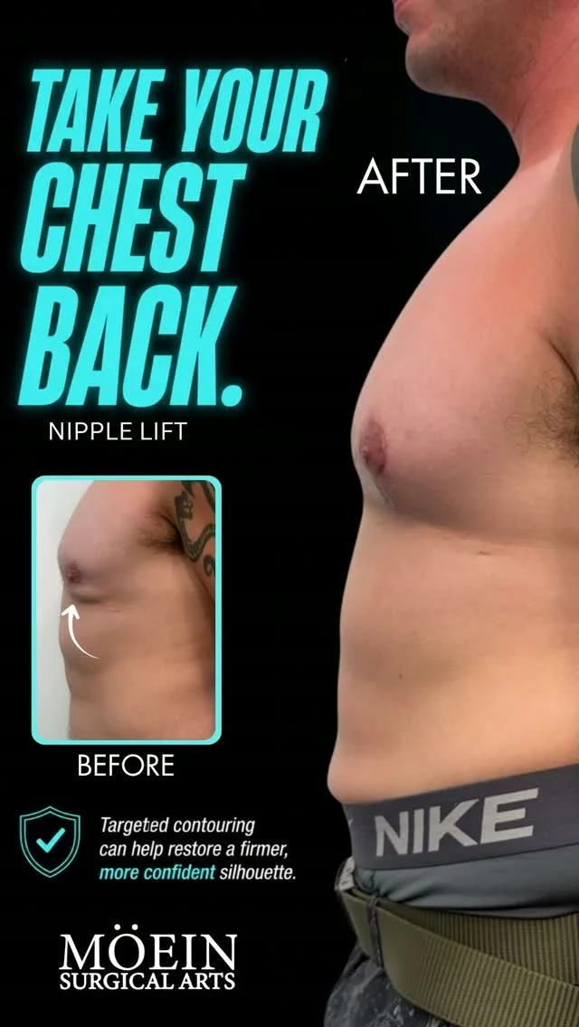 Watch a Complete Nipple Lift Surgery Transformation 🎥✨

Ever wonder how nipple position can be improved to create a more balanced and aesthetically pleasing breast appearance?
In this video, you'll see the procedure from start to finish as Dr. Moein performs a customized Nipple Lift Surgery, carefully repositioning the nipple and areola to achieve improved symmetry and proportion.

This procedure may include:
✨ Nipple Lift to correct downward-pointing or asymmetrical nipples
✨ Areola reshaping to improve proportion and overall breast aesthetics
✨ Customized surgical techniques based on each patient's anatomy and desired outcome

Every patient is unique, which is why every surgical plan is personalized to their anatomy, concerns, and goals.

🎥 Watch the full procedure to see how precise surgical techniques can enhance nipple position and create a more balanced breast appearance.
💬 Have questions about nipple lift surgery, recovery, or whether you're a candidate? Leave a comment or send us a DM.

📍 Moein Surgical Arts
📞 (310) 861-4093
🌐 moeinsurgicalarts.com

#NippleLift #NippleLiftSurgery #BreastSurgery #BreastLift #BreastAesthetics