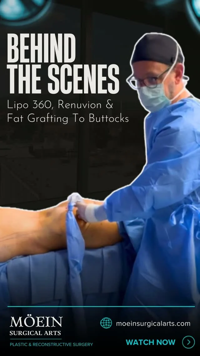 Behind the Scenes: Sculpted & Snatched — Liposuction 360, Renuvion & Fat Grafting to Buttocks ✨

Step inside the operating room and see how precision, artistry, and personalized surgical planning come together to create a fully sculpted, balanced silhouette.

Liposuction 360 with Renuvion skin tightening and fat grafting to the buttocks is designed to contour the entire midsection — waist, abdomen, flanks, and back — while transferring purified fat to enhance and lift the buttocks. Every treatment is carefully customized to the patient's anatomy, goals, and desired shape.

✨ 360° waistline sculpting
 ✨ Renuvion skin tightening for smoother results
 ✨ Natural fat transfer for fuller, lifted curves
 ✨ Personalized full-body contouring plan

This is more than liposuction—it's about creating harmony between your natural body and the curves you've always envisioned for yourself.
💬 What would you like to see more of behind the scenes? Let us know in the comments below! 👇

📍 Moein Surgical Arts
 📲 DM "CURVES" to learn more or schedule your private consultation.
 .
 .
 #Lipo360 #Renuvion #FatGrafting #BBL #BodyContouring #MoeinSurgicalArts