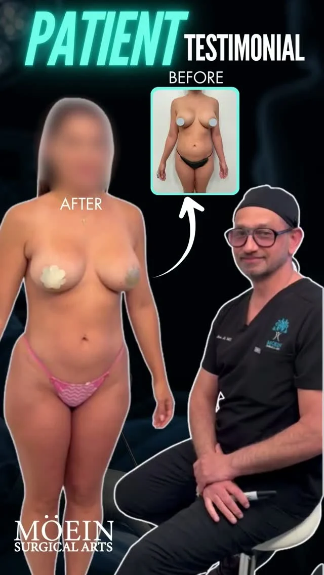 Patient Testimonial — Liposuction 360 + Renuvion + Fat Grafting ✨

Sometimes the biggest transformation isn’t just about looking different…
It’s about feeling more confident in your own body.

This patient shares their experience after Liposuction 360, Renuvion Skin Tightening, and Fat Grafting to the Buttocks—a customized combination designed to refine overall body contours and enhance natural proportions.
✨ More defined waistline
✨ Sculpted abdomen and back
✨ Improved skin tightness
✨ Enhanced buttock shape and volume
✨ More balanced, natural-looking contours

Liposuction 360 targets stubborn fat around the abdomen, waist, flanks, and back, while Renuvion Skin Tightening can help improve the appearance of loose or lax skin. Fat grafting to the buttocks can then be used to enhance shape and proportion.

Every body is different, and treatment plans are customized to each patient’s anatomy and aesthetic goals.
✨ Sculpted. Refined. Confidence restored.

💬 Real question:
What area of your body would you most like to improve?
Comment below—we’re happy to answer your questions. 👇

🎥 Want to learn how Liposuction 360 + Renuvion + Fat Grafting works and who may be a good candidate?
Comment “BODY” and we’ll send you the full breakdown.

📍 Moein Surgical Arts
📲 DM “BODY” to schedule your private consultation.

#DrMoein #Liposuction360 #Renuvion #FatGrafting #BodyContouring