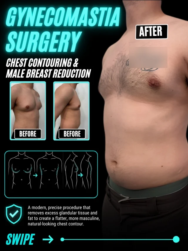 NO MORE PUFFY CHEST. JUST A STRONGER LOOK. 🔥

Behind the scenes of Gynecomastia Surgery, designed specifically for men looking to reduce excess chest tissue and achieve a flatter, more defined masculine chest.
✨ Flatter chest
✨ More masculine definition
✨ Reduced excess tissue & fat
✨ Better overall proportions

The goal? A natural-looking chest that fits your physique.
📍 Moein Surgical Arts
📲 DM “CHEST” to learn more or schedule your private consultation.
.
.
#Gynecomastia #GynecomastiaSurgery #MaleChest #drmoein #moeinsurgicalarts