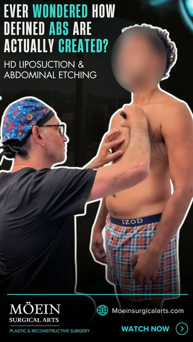 Ever Wondered How Defined Abs Are Actually Created- HD Liposuction + Ab Etching 🔥

Step inside the operating room and get a closer look at how precision, technique, and detailed surgical planning come together to create a more defined physique.
HD Liposuction + Ab Etching is designed to go beyond simply removing fat. The goal is to carefully sculpt the body while enhancing natural muscle definition and creating sharper abdominal contours.

✨ High-definition body sculpting
✨ Strategic removal of stubborn fat
✨ Enhanced abdominal definition
✨ More sculpted waist and torso
✨ Precise contouring around natural muscle anatomy
✨ Personalized surgical approach

Every movement matters. From fat removal to detailed etching, the procedure is carefully performed to create definition that complements the patient’s natural anatomy.

The goal isn’t just to get leaner—it’s to sculpt, define, and enhance the physique from every angle.
💬 What part of the HD Lipo + Ab Etching process would you like to see more of behind the scenes? Let us know in the comments! 👇
📍 Moein Surgical Arts
📲 DM “SCULPT” to learn more or schedule your private consultation.
.
.
#HDLipo #AbEtching #HighDefinitionLiposuction #AbEtchingSurgery