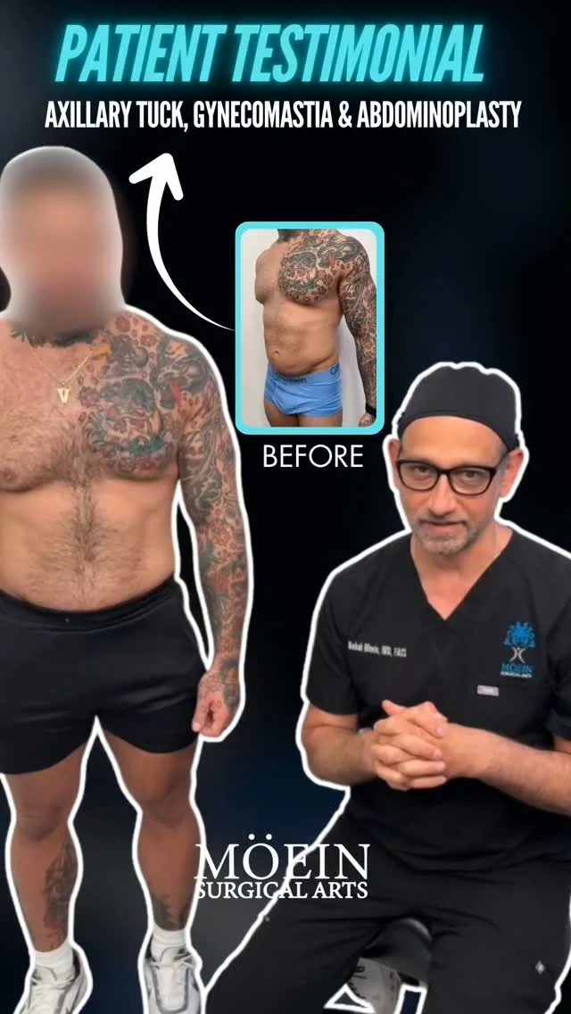Patient Testimonial — Axillary Tuck + Gynecomastia + Abdominoplasty ✨

Sometimes the biggest transformation isn’t just about looking different…
It’s about feeling more confident in your own body.

This patient shares their experience after Axillary Tuck, Gynecomastia Surgery, and Abdominoplasty—a customized combination designed to address excess skin and tissue while creating a more defined, balanced overall appearance.

✨ More defined chest
✨ Improved abdominal contour
✨ Reduced excess skin and tissue
✨ Refined underarm area
✨ More balanced, masculine proportions

Gynecomastia Surgery can address excess glandular tissue and fat in the chest to create a flatter, more masculine contour. Abdominoplasty can remove excess abdominal skin and help create a firmer, more defined midsection, while an Axillary Tuck can address excess skin in the underarm area.

Every body is different, and treatment plans are customized to each patient’s anatomy and aesthetic goals.

✨ Sculpted. Refined. Confidence restored.

💬 Real question:
What area of your body would you most like to improve?
Comment below—we’re happy to answer your questions. 👇

🎥 Want to learn how Axillary Tuck + Gynecomastia Surgery + Abdominoplasty works and who may be a good candidate?
Comment “BODY” and we’ll send you the full breakdown.

📍 Moein Surgical Arts
📲 DM “BODY” to schedule your private consultation.

#DrMoein #GynecomastiaSurgery #Abdominoplasty #AxillaryTuck #BodyContouring