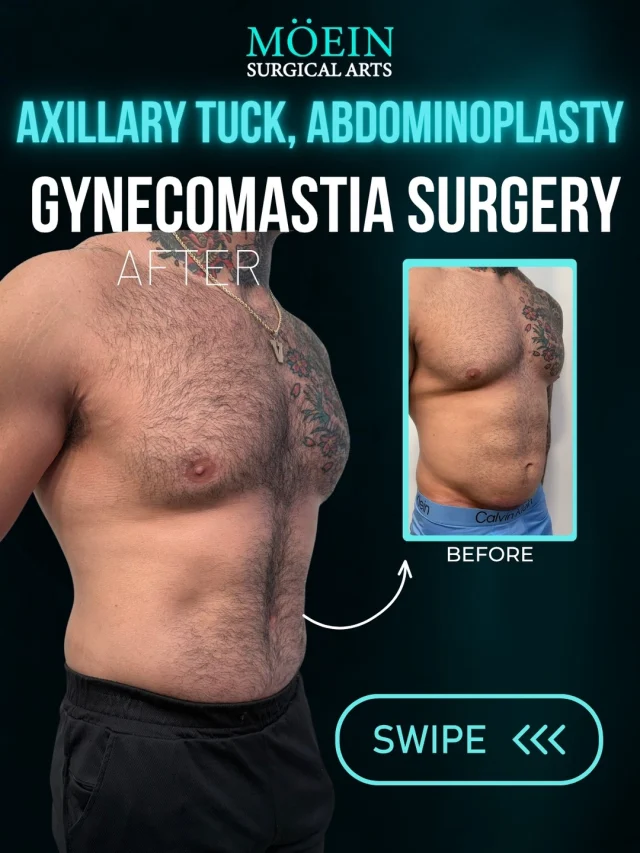Axillary Tuck + Gynecomastia Surgery + Abdominoplasty ✨

A more sculpted chest, smoother underarms, and a tighter core can completely transform your overall silhouette.
BEFORE
 ❌ Excess skin and fat around the underarms/axillary area
 ❌ Enlarged or puffy chest tissue (gynecomastia)
 ❌ Loose, stretched abdominal skin and muscle separation
 ❌ Difficulty achieving a flat, masculine chest and core contour
AFTER
 ✔ Smoother, tighter underarm and side-chest area
 ✔ Flatter, more contoured, masculine chest
 ✔ Tight, defined abdominal wall
 ✔ Improved definition through the chest, sides, and core
 ✔ More balanced, proportionate upper-body silhouette

Axillary tuck removes excess skin and fat from the underarm/bra-line area for a smoother, tighter contour — often paired with upper body procedures for a more complete result. Gynecomastia surgery addresses enlarged or puffy chest tissue by removing excess glandular tissue and fat, restoring a flatter, more masculine chest contour. Abdominoplasty (tummy tuck) removes excess abdominal skin, repairs separated muscles, and tightens the core for a firmer, more defined midsection.

Every treatment plan is customized to the patient's anatomy and aesthetic goals, with a focus on balanced, natural-looking results.
If you're ready to reshape your silhouette, it may be time to explore your options.

📲 Ready to start your journey? DM me to book your consultation
 📞 (310) 861-3176
 🌐 www.moeinsurgicalarts.com
 📧 appointment@msurgicalarts.com

#drmoein #axillarytuck #gynecomastiasurgery #abdominoplasty