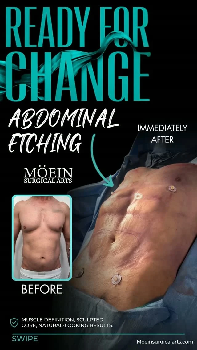 Abdominal Etching ✨

A more defined abdomen can transform the overall appearance of your physique, creating sharper contours and a more athletic-looking silhouette.
BEFORE
❌ Less-defined abdominal contours
❌ Stubborn fat masking natural muscle definition
❌ Difficulty achieving visible abdominal lines
❌ Uneven or less-sculpted appearance

AFTER
✔ More defined abdominal contours
✔ Enhanced appearance of the abdominal muscles
✔ Sharper, more sculpted midsection
✔ More athletic-looking abdominal definition
✔ Improved overall abdominal contour

Abdominal Etching uses precise liposuction techniques to strategically sculpt around the natural lines of the abdominal muscles, helping create a more defined and athletic appearance.

Every procedure is customized to the patient's anatomy and aesthetic goals, with the goal of creating balanced and natural-looking definition.
If you're looking for a more sculpted and defined abdomen, it may be time to explore your options.

📲 Ready to start your journey? DM me to book your consultation
📞 (310) 861-3176
🌐 www.moeinsurgicalarts.com
📧 appointment@msurgicalarts.com

#drmoein #abdominaletching #abetching #sixpackabs #bodycontouring
