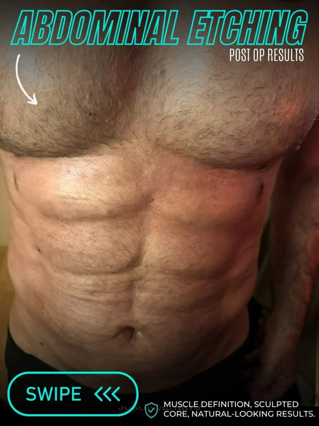 Abdominal Etching 💪✨

Not just muscle definition—it's about sculpting the details that make your physique stand out. 🔥

✨ Enhanced six-pack definition
 ✨ Sharper abdominal contours
 ✨ A more athletic, sculpted appearance

Precision abdominal etching by Dr. Moein, customized to complement your natural physique.

💪 Ready to define your look? DM us to learn more!

📞 (310) 861-3176
🌐 moeinsurgicalarts.com
📧 appointment@msurgicalarts.com

#DrMoein #AbdominalEtching #SixPackSurgery #MoeinSurgicalArts #BodyContouring