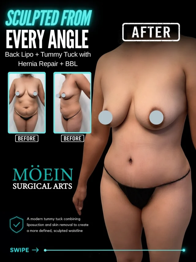 Complete Body Transformation ✨

Back Liposuction + Tummy Tuck with Hernia Repair + BBL

A more defined waist, flatter abdomen, and enhanced curves can help create a smoother, more balanced body silhouette.

BEFORE 
❌ Stubborn fat around the back and waist 
❌ Loose abdominal skin and excess fullness
 ❌ Abdominal muscle concerns and hernia 
❌ Limited waist definition 
❌ Less buttock volume and projection

AFTER 
✔ More sculpted back and waistline 
✔ Flatter, firmer abdominal contour 
✔ Hernia repair combined with tummy tuck 
✔ Enhanced buttock shape and volume 
✔ A smoother, more balanced silhouette

Every transformation is customized to the patient's anatomy and goals, with a focus on body contouring, abdominal repair, and natural-looking proportions.

✨ Ready to explore your transformation?
📲 DM us to learn more about your options. 
📞 (310) 861-3176 
🌐 www.moeinsurgicalarts.com 
📧 appointment@msurgicalarts.com

#DrMoein #TummyTuck #HerniaRepair #BackLiposuction #BBLSurgery