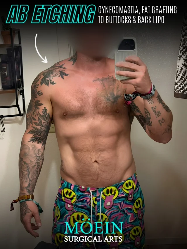 Abdominal Etching + Gynecomastia + Back Lipo & Fat Grafting to Buttocks 💪✨

A comprehensive body contouring transformation designed to create more definition, balance, and proportion throughout the body.
✨ Abdominal etching for enhanced muscle definition
✨ Gynecomastia surgery for a flatter, more defined chest
✨ Back liposuction to refine the back and waistline
✨ Fat grafting to the buttocks for added shape and volume

Each procedure is carefully customized by Dr. Moein to complement the patient’s natural anatomy and overall physique.

💪 Looking to enhance your body contours? DM us to learn more.
📞 (310) 861-3176
🌐 moeinsurgicalarts.com
📧 appointment@msurgicalarts.com

#DrMoein #AbdominalEtching #Gynecomastia #BackLipo #FatGrafting