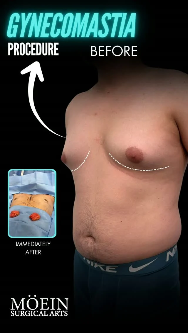 Watch a Complete Gynecomastia Surgery Transformation 🎥✨

Ever wonder how gynecomastia surgery can help create a flatter, more masculine-looking chest?
In this video, you’ll see the procedure from start to finish as Dr. Moein performs customized Gynecomastia Surgery, carefully addressing excess glandular tissue and fat to improve chest contour and symmetry.

Every patient is unique, which is why every surgical plan is personalized to their anatomy, concerns, and desired outcome.

🎥 Watch the full procedure to see how precise surgical techniques can help create a flatter, more defined chest.

💬 Have questions about gynecomastia surgery, recovery, or whether you’re a candidate? Leave a comment or send us a DM.

📍 Moein Surgical Arts
📞 (310) 861-4093
🌐 moeinsurgicalarts.com

#Gynecomastia #GynecomastiaSurgery #MaleBreastReduction #ChestContouring #DrMoein