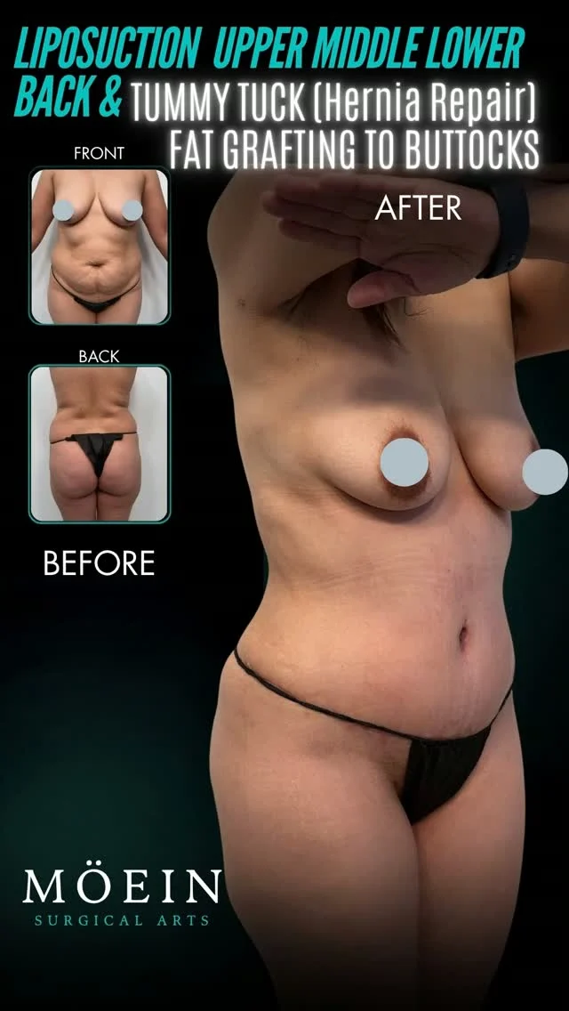 Tummy Tuck + Hernia Repair + Back Liposuction + Fat Grafting to Buttocks ✨

A combined body transformation that addresses the abdomen, back, and buttocks together, for a more balanced, proportioned silhouette.
BEFORE
 ❌ Excess skin and fat around the abdomen
 ❌ Weakened abdominal wall or hernia
 ❌ Fullness across the upper, middle, and lower back
 ❌ Lack of volume and shape in the buttocks
AFTER
 ✔ A flatter, firmer-looking abdomen
 ✔ Hernia repaired and abdominal wall tightened
 ✔ Smoother, more contoured back
 ✔ Fuller, more shapely buttocks using your own fat
 ✔ A more balanced overall silhouette

What this procedure includes:
 🔹 Liposuction of the upper, middle, and lower back: removes stubborn fat and refines the contours of the torso
 🔹 Tummy tuck (abdominoplasty) with hernia repair: removes excess skin, tightens the abdominal muscles, and repairs the hernia
 🔹 Fat grafting to the buttocks: fat harvested during liposuction is purified and transferred to enhance buttock shape and volume

Every plan is customized to your anatomy and goals, with a focus on natural-looking, proportionate results. Candidacy, surgical plan, and expected results are discussed during your consultation. Individual results vary.

📲 Ready to start your journey? DM me to book your consultation
 📞 (310) 861-3176
 🌐 www.moeinsurgicalarts.com
 📧 appointment@msurgicalarts.com

#drmoein #tummytuck #abdominoplasty #herniarepair #backliposuction