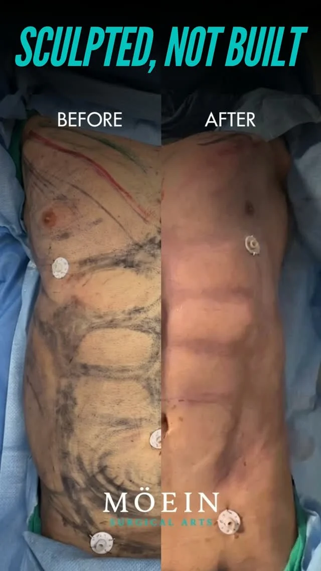 SCULPTED, NOT BUILT — Abdominal Etching ✨

Step inside the operating room and see how precision, technique, and personalized surgical planning come together in abdominal etching to enhance the appearance of natural abdominal definition.

Abdominal etching is a specialized body-contouring procedure designed to create more visible abdominal lines and muscle definition by strategically removing fat around the natural contours of the abdominal muscles.

✨ Enhanced abdominal definition
✨ More visible muscle contours
✨ A more sculpted midsection
✨ Emphasis on natural anatomical lines
✨ A personalized approach to body contouring

The goal isn’t to build muscles through surgery—it’s to enhance the definition of the abdominal contours for a more athletic, sculpted appearance.

💬 What would you like to know about abdominal etching? Let us know in the comments below! 👇
📍 Moein Surgical Arts
📲 DM “ETCHING” to learn more or schedule your private consultation.
.
.
#AbdominalEtching #SculptedNotBuilt #SixPackSurgery #BodyContouring #DrMoein