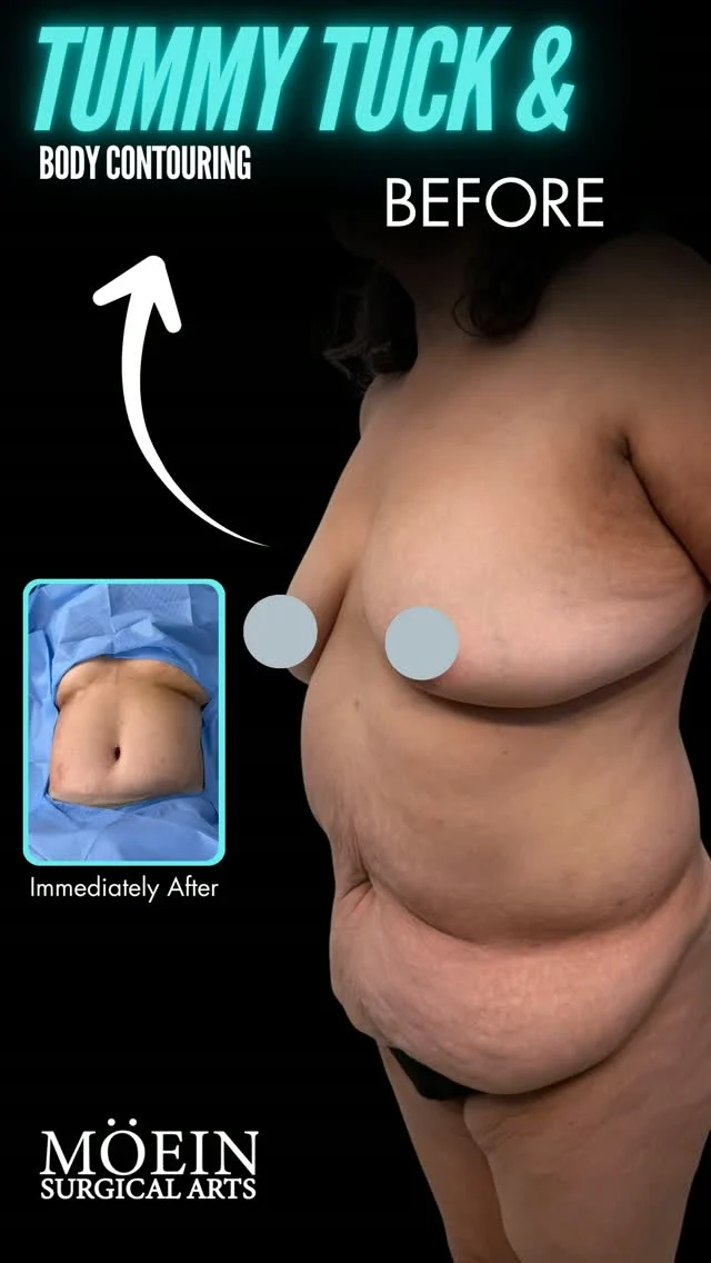 Tummy Tuck & Body Contouring ✨

Discover how surgical precision and personalized techniques can help reshape the abdomen, remove excess skin, and create smoother, more balanced body contours.

✨ Excess skin removal
✨ Refined abdominal contours
✨ Improved body proportions
✨ Personalized surgical approach

📍 Moein Surgical Arts

💬 DM us to learn more about your options.

#TummyTuck #BodyContouring #MoeinSurgicalArts #DrMoein