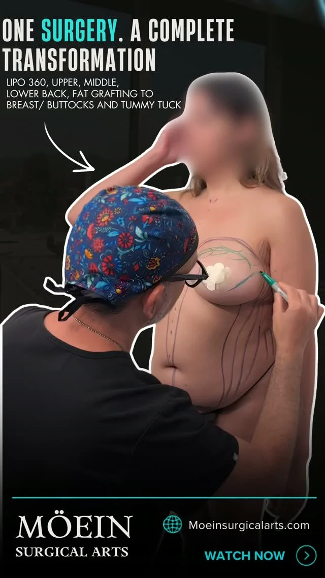 One Surgery, Complete Transformation — Lipo 360 + Tummy Tuck + Fat Grafting ✨💪

Step inside the operating room and see how precision, technique, and personalized surgical planning come together in a comprehensive body contouring procedure.

This combination of Lipo 360, upper, middle, and lower back liposuction, fat grafting to the breasts and buttocks, and a tummy tuck is designed to address multiple areas of the body while enhancing overall shape and proportion.

✨ Lipo 360 for comprehensive torso contouring
✨ Upper, Middle & Lower Back Liposuction to refine back contours
✨ Fat Grafting to the Breasts to enhance shape and volume
✨ Fat Grafting to the Buttocks to improve fullness and contour
✨ Tummy Tuck to remove excess abdominal skin and create a smoother abdominal profile

Every procedure is carefully customized by Dr. Moein based on the patient’s anatomy, surgical needs, and aesthetic goals.

The focus is on creating balanced contours and a harmonious silhouette through a personalized surgical approach.

💬 What would you like to see more of behind the scenes? Let us know in the comments below! 👇

📍 Moein Surgical Arts
📲 DM us to learn more about your body contouring options.
.
.
#DrMoein #Lipo360 #BackLiposuction #TummyTuck #FatGrafting #BodyContouring #MoeinSurgicalArts