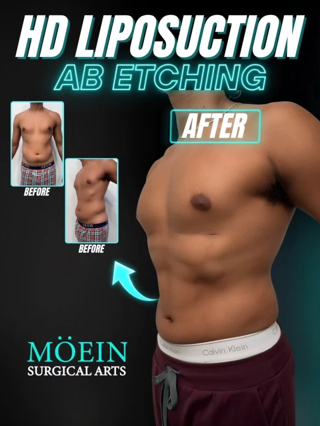 HD Liposuction & Ab Etching 💪✨

A sculpted, athletic physique isn't just about losing fat—it's about revealing the right contours and enhancing natural muscle definition.

BEFORE ❌ Stubborn fat hiding abdominal definition
❌ Lack of visible muscle contours
❌ Uneven body proportions around the waist and abdomen
❌ Feeling less confident in fitted shirts, at the gym, or by the pool

AFTER ✔ Enhanced abdominal muscle definition
✔ A more sculpted, athletic-looking midsection
✔ Improved waistline contour and body proportions
✔ A more defined, masculine appearance

HD liposuction and abdominal etching are designed to refine body contours and enhance the appearance of the underlying abdominal muscles. By carefully removing targeted fat while preserving strategic areas, these procedures can help create a more defined, athletic look. Every treatment plan is customized to the individual's anatomy, goals, and suitability for surgery.

Ready to explore your body contouring options?

📲 DM us for more information and to discuss your goals.

📞 (310) 861-3176
🌐 www.moeinsurgicalarts.com
📧 appointment@msurgicalarts.com

#DrMoein #HDLipo #AbEtching #MoeinSurgicalArts