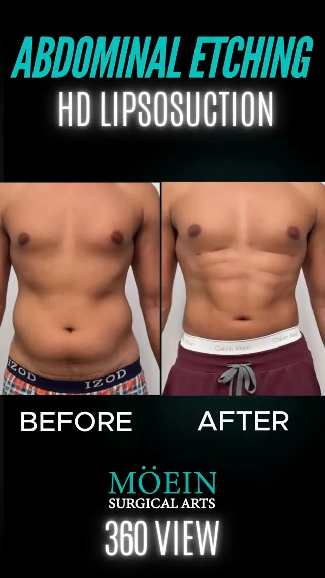 360° View HD Liposuction & Ab Etching 💪✨

A sculpted, athletic physique isn't just about losing fat—it's about revealing the right contours and enhancing natural muscle definition from every angle.

360° VIEW 🔄

✔ A complete view of the patient's physique from multiple angles 
✔ Enhanced visibility of abdominal muscle definition 
✔ A closer look at waistline contour and body proportions 
✔ A sculpted, athletic-looking appearance from every angle 

HD liposuction and abdominal etching are designed to refine body contours and enhance the appearance of the underlying abdominal muscles. This 360° view showcases the patient's physique from different angles, highlighting the abdominal area, waistline, and overall body contours.

Every treatment plan is customized to the individual's anatomy, goals, and suitability for surgery.

Ready to explore your body contouring options?

📲 DM us for more information and to discuss your goals.

📞 (310) 861-3176 
🌐 www.moeinsurgicalarts.com 
📧 appointment@msurgicalarts.com

#DrMoein #HDLipo #AbEtching #BodyContouring #MoeinSurgicalArts
