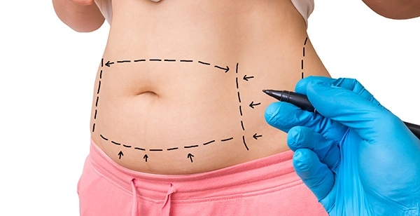 A woman's stomach is being marked for liposuction in Los Angeles.