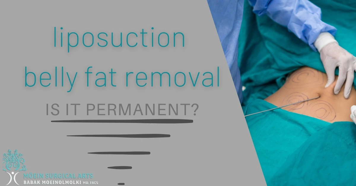 Belly Fat Liposuction