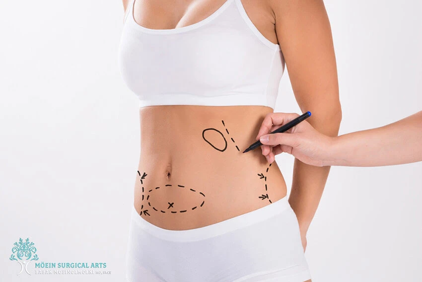 Benefits of Lipo Procedure