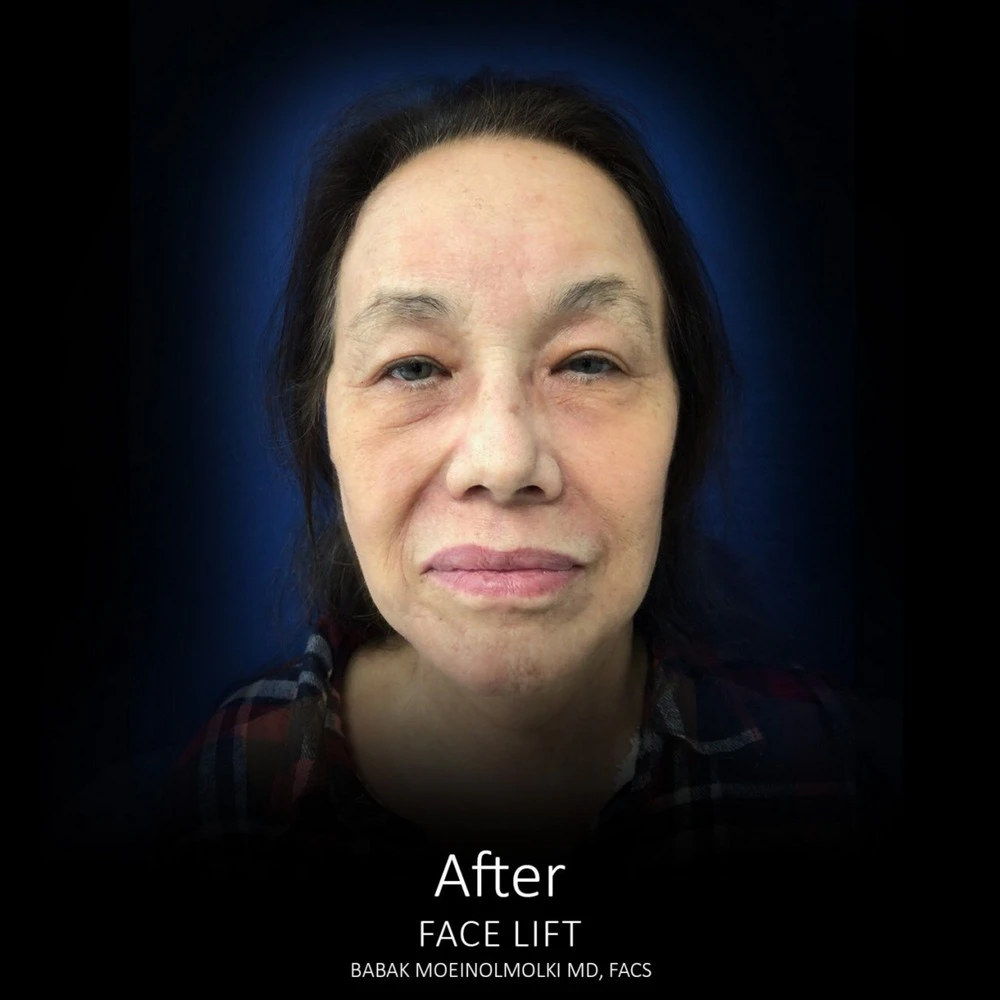 Before and after images of a woman's face post face lift.